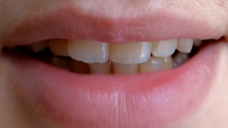 Dental Appliance, Device, Tooth, Crown, Dental Implant, Mouth